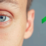 Glaucoma