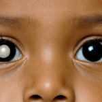 Retinoblastoma infantil