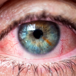 tratamento para olho seco