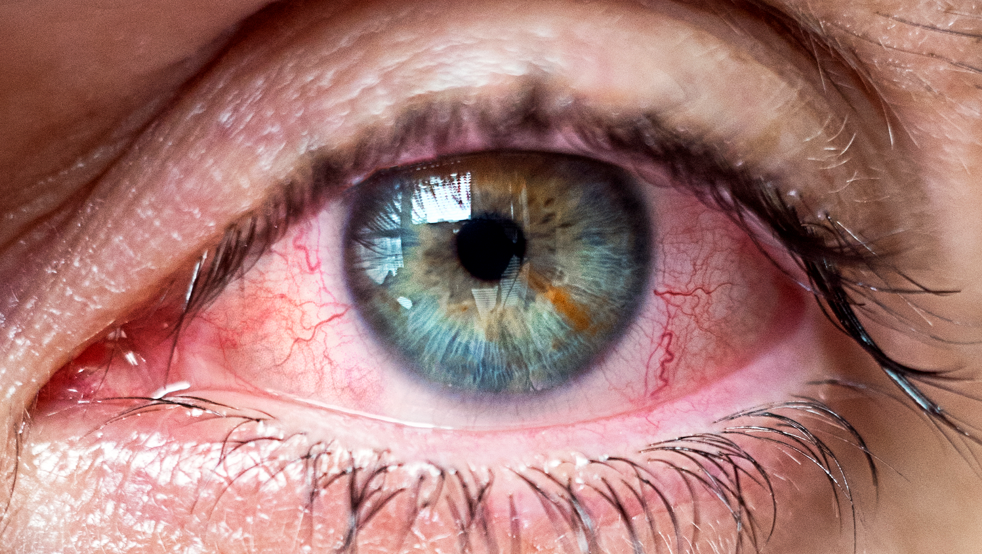 tratamento para olho seco